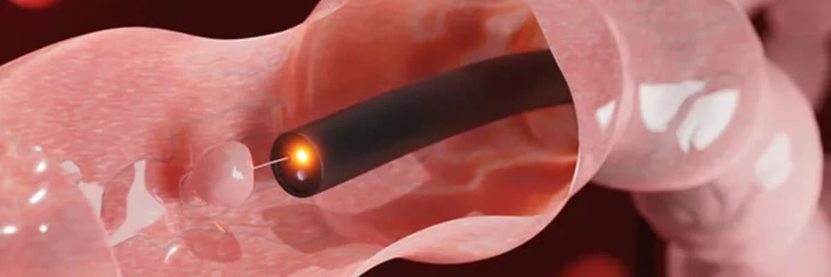 Kolonoskopi nedir ? Kimlere Kolonoskopi Yapılır?