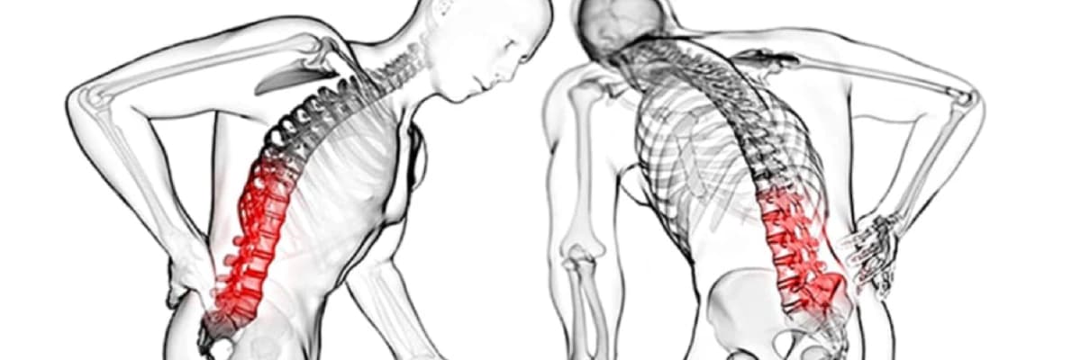 ANKİLOZAN SPONDİLİT HASTALIĞI, TANISI VE HASTAYI İYİLEŞTİRİCİ YAKLAŞIMLAR