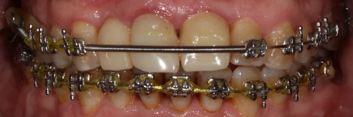 Dişeti hastalığı ve ortodonti