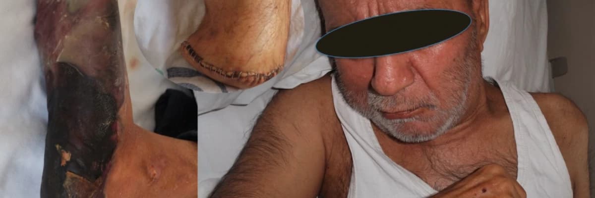 Buerger Hastalığı Nedir?