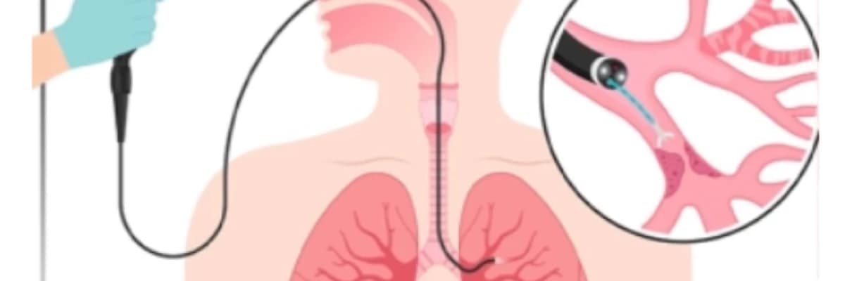 Endobronşiyal Ultrason (EBUS): Akciğerlerin Gizemli Dünyasına Yolculuk
