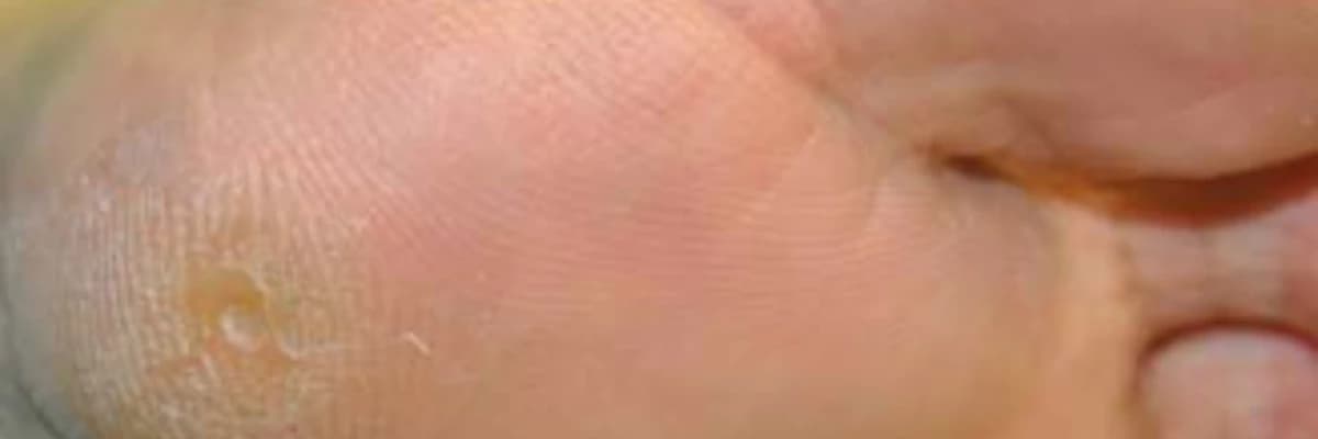 Bizarre parosteal osteochondromatous proliferation (Nora's lesion) in the medial sesamoid of the first toe