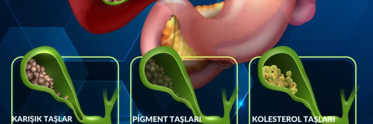 Safra Kesesi Taşı : Tanı ve Tedavi Yöntemleri