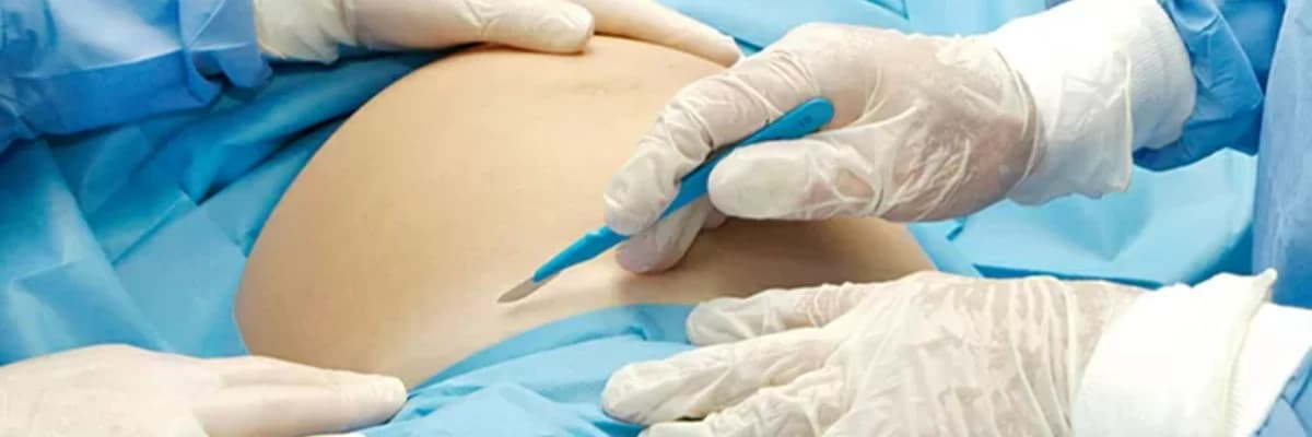 Sezaryen Sırasında Myom Ameliyatı: Riskler, Faydalar ve Dikkat Edilmesi Gerekenler