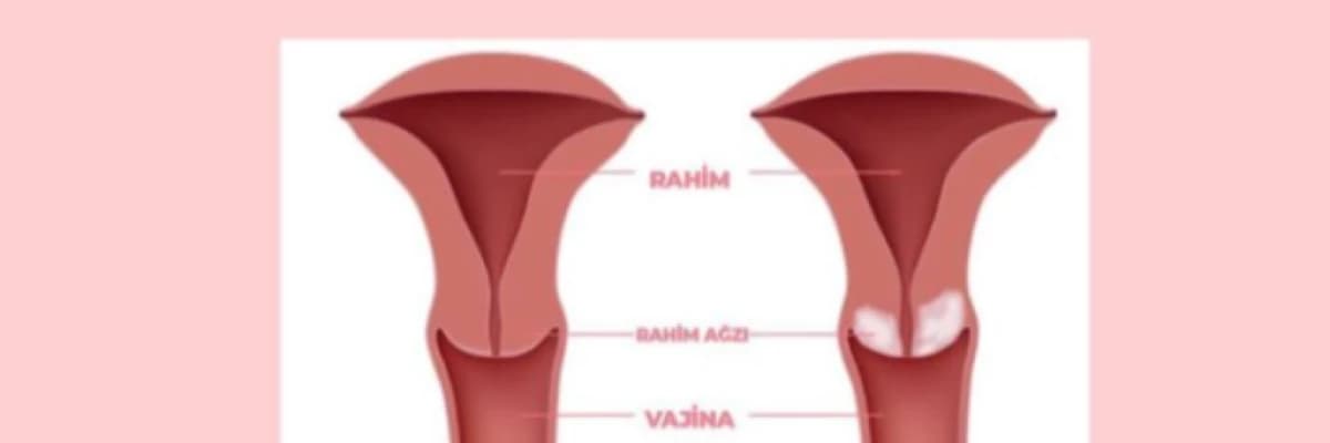 Rahim Ağzı Kanserinin İlk Belirtileri Nelerdir?