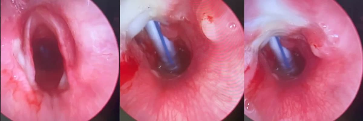 Çocuklarda trakeotomi kapatılması nasıl yapılmalıdır?