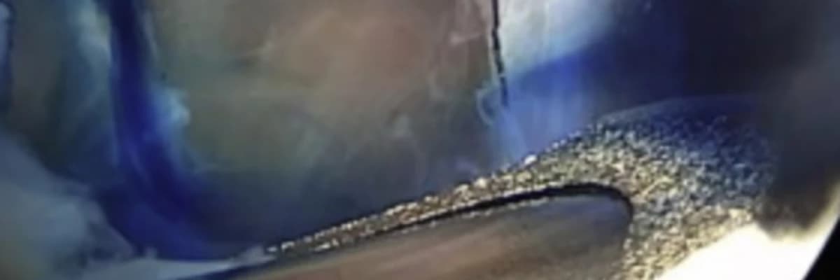 Ultrasound-guided intralesional methylene blue injection for the arthroscopic decompression of spinoglenoid notch cyst causing suprascapular neuropathy