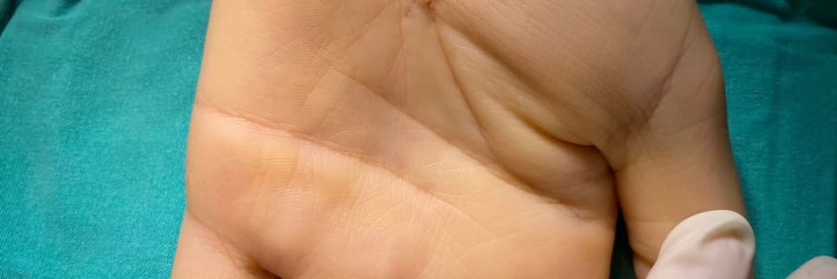 Karpal Tünel Sendromu