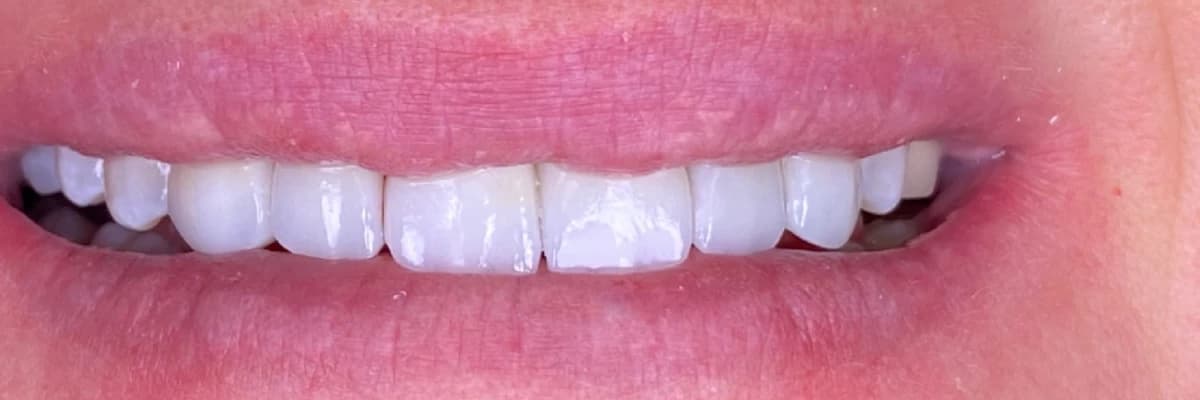 Gülüş Tasarımı Sonrası: Sağlıklı ve Etkili Bakım İpuçları