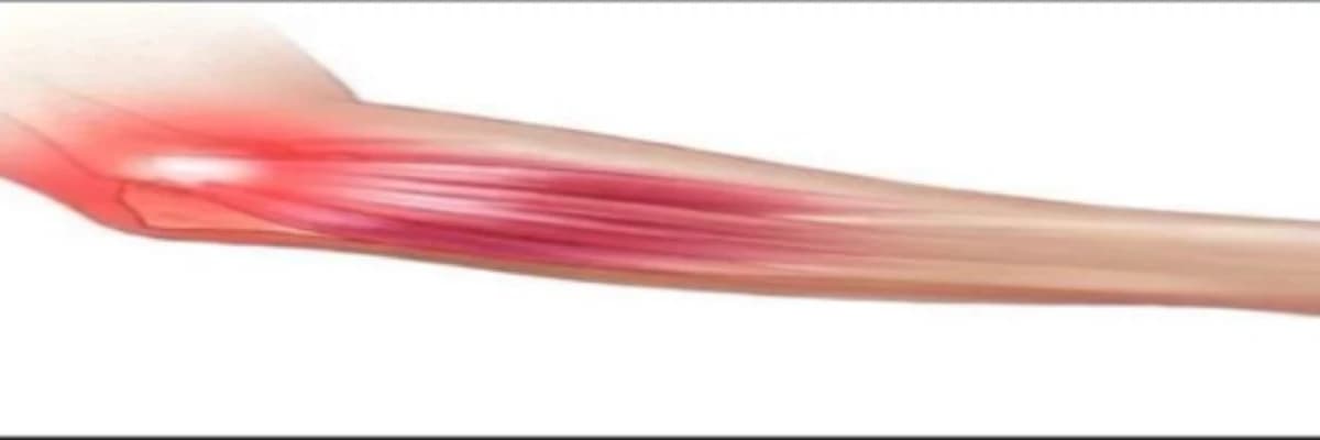 Tenisçi Dirseği (Lateral Epikondilit) Nedir? Belirtileri Nelerdir? Fizyoterapi ile Yüz Güldüren Sonuçlar