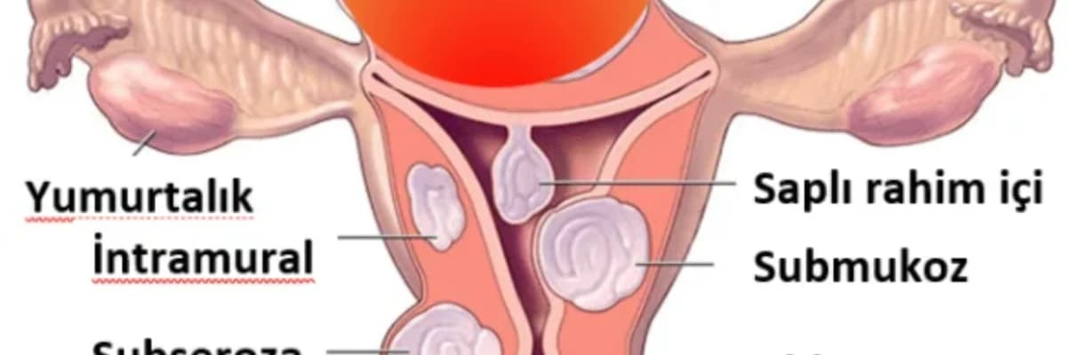 ENDOMETRİAL POLİP TEDAVİSİ