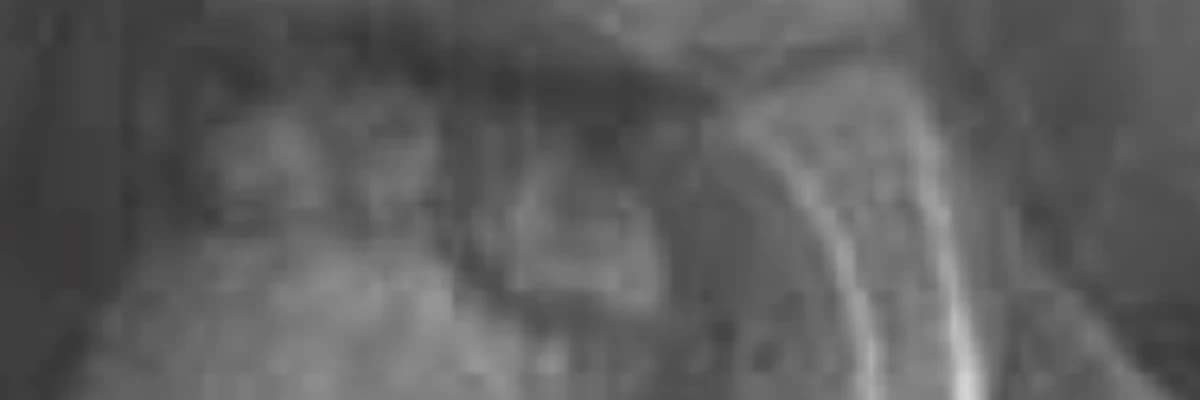 Neutrophil to lymphocyte ratio may be a predictive marker of poor prognosis in Legg-Calvé-Perthes disease