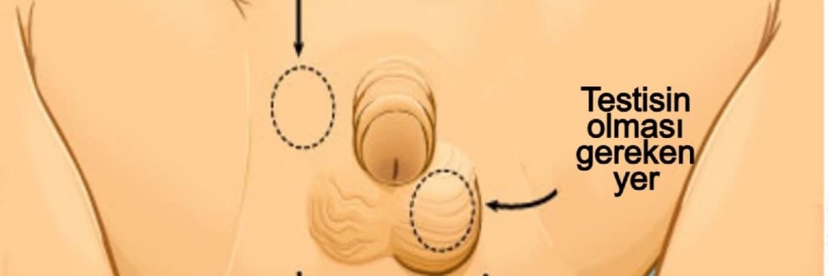 İnmemiş testis (kriptorkidizm) ve asansör testis (retraktil testis) nedir?
