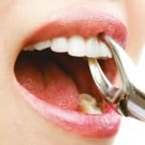 DİŞ ÇEKİMİ VE SONRASI hakkında merak edilenler