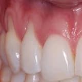 Diş Eti Çekilmesi Nedir, Nasıl Tedavi Edilir?