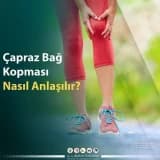 Çapraz Bağ Kopması Nasıl Anlaşılır?