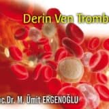 Derin ven trombozu (dvt) hakkında bilmemiz gerekenler