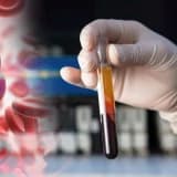 Platelet Rich Plasma - PRP