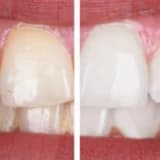 DİŞ BEYAZLATMA (BLEACHİNG)