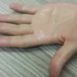 El ve Koltuk altı Aşırı Terleme Tedavisi