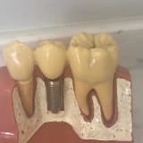 İMPLANTA NEDEN İHTİYAÇ DUYARIZ VE İMPLANTIN ÖMRÜ NE KADARDIR