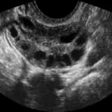 Polikistik Over Sendromu