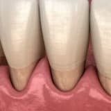 DİŞ ETİ ÇEKİLMESİ