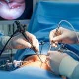 Laparoskopik Ameliyatların Hasta İçin Avantajları