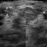 Fibroadenom ile Meme Kanseri İlişkisi