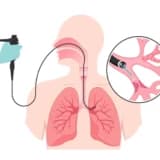 Endobronşiyal Ultrason (EBUS): Akciğerlerin Gizemli Dünyasına Yolculuk