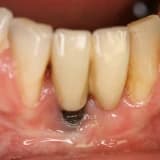 İmplant Sonrası Ağız Hijyeni ve Peri-implantitis