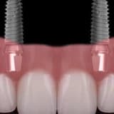 ALL-ON-FOUR İMPLANT