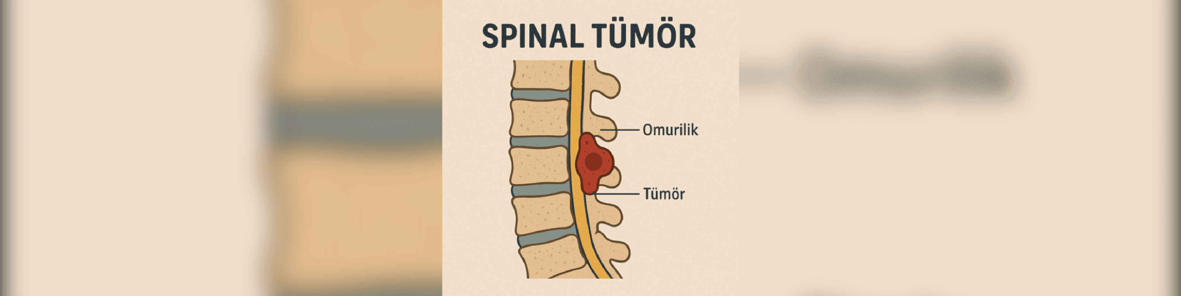 Spinal Tümör Nedir? Belirtileri Nelerdir?